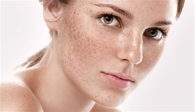 Nám da mặt là gì ? Cách trị nám da mặt hiệu quả ?
